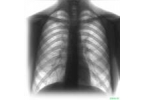 Туберкулез — инфекционная болезнь