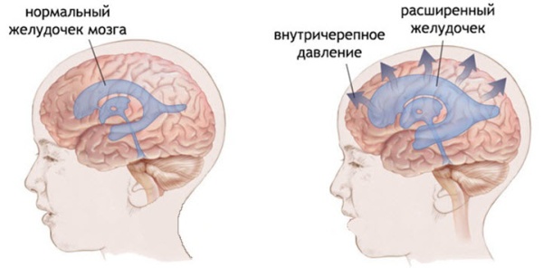 Внутричерепное давление у детей фото