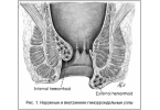 Народное лечение гемороя