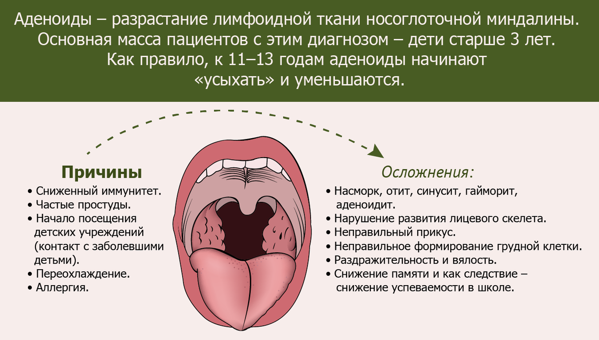 Аденоиды и хронический тонзиллит