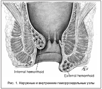 Народное лечение гемороя