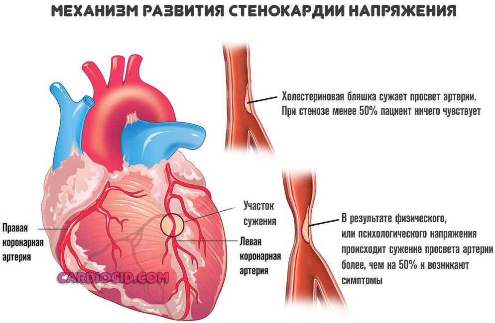 Сердце при стенокордии