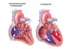 Врожденные пороки сердца