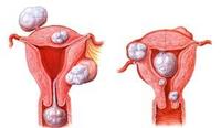 Миома матки