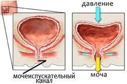 Недержание мочи у женщин