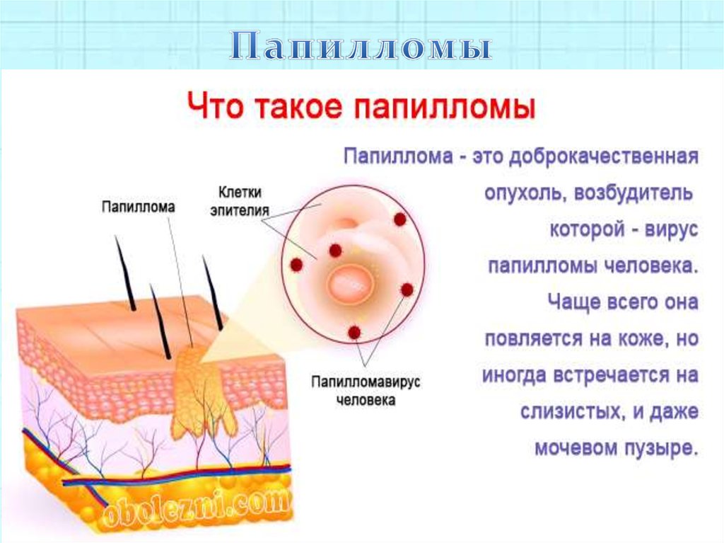 Папиллома