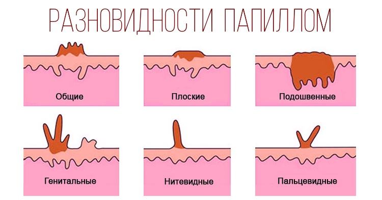 Виды папиллом