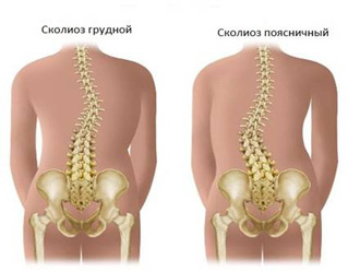 Виды сколиоза. Лечение сколиоза