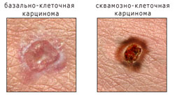 Рак кожи – карцинома