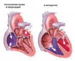 Врожденные пороки сердца