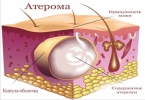 Абсцесс