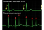 Аритмия сердца