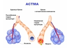 Бронхиальная астма