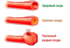 Геморрой