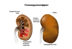 Гломерулонефрит