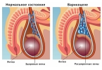 Варикоцеле