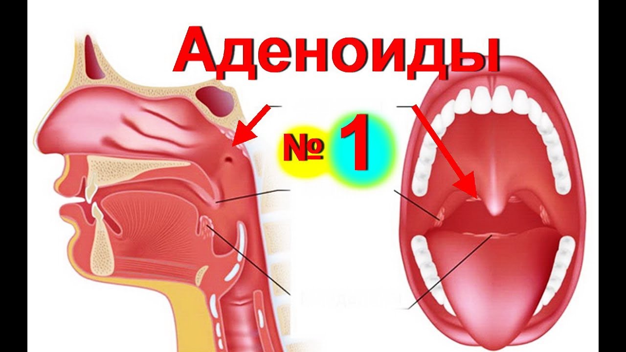 Аденоиды