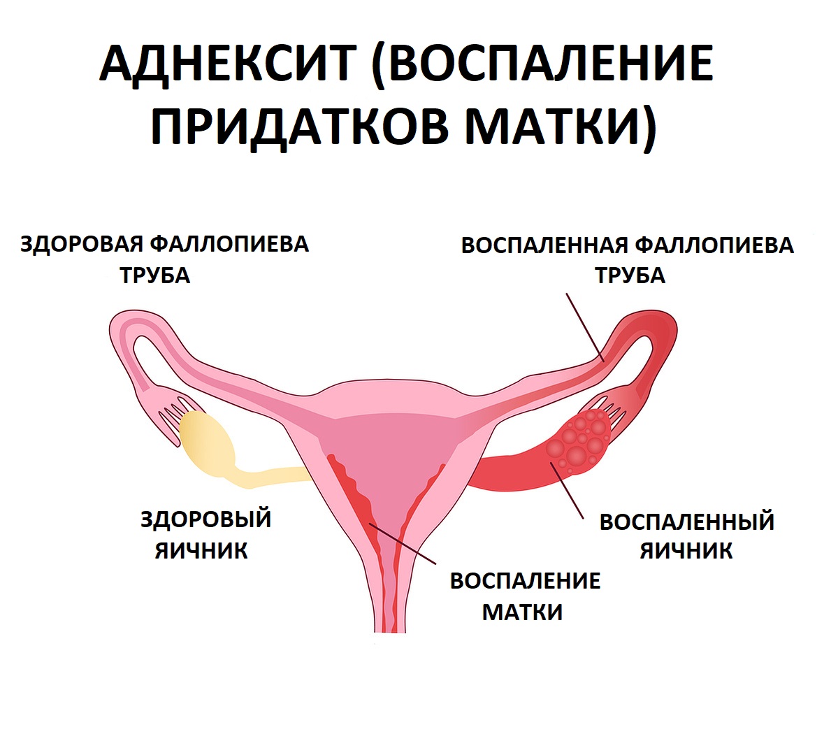 Аднексит