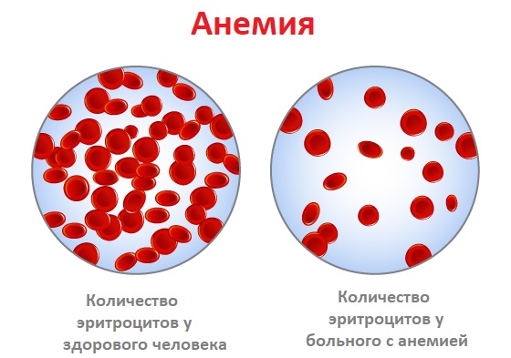 Анемия