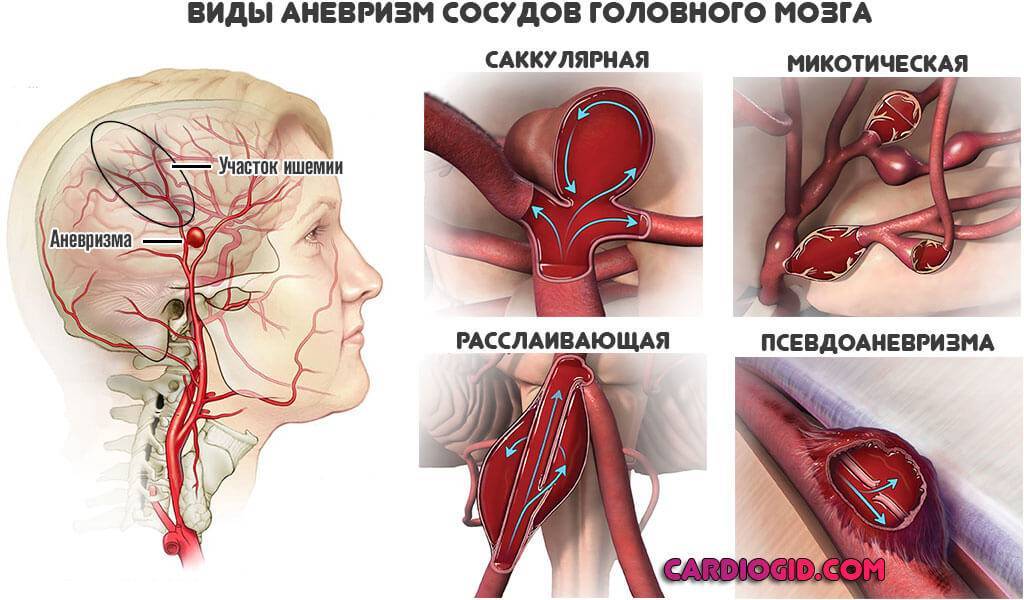 Аневризма