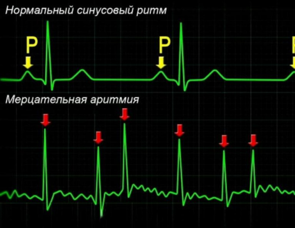 Аритмия сердца