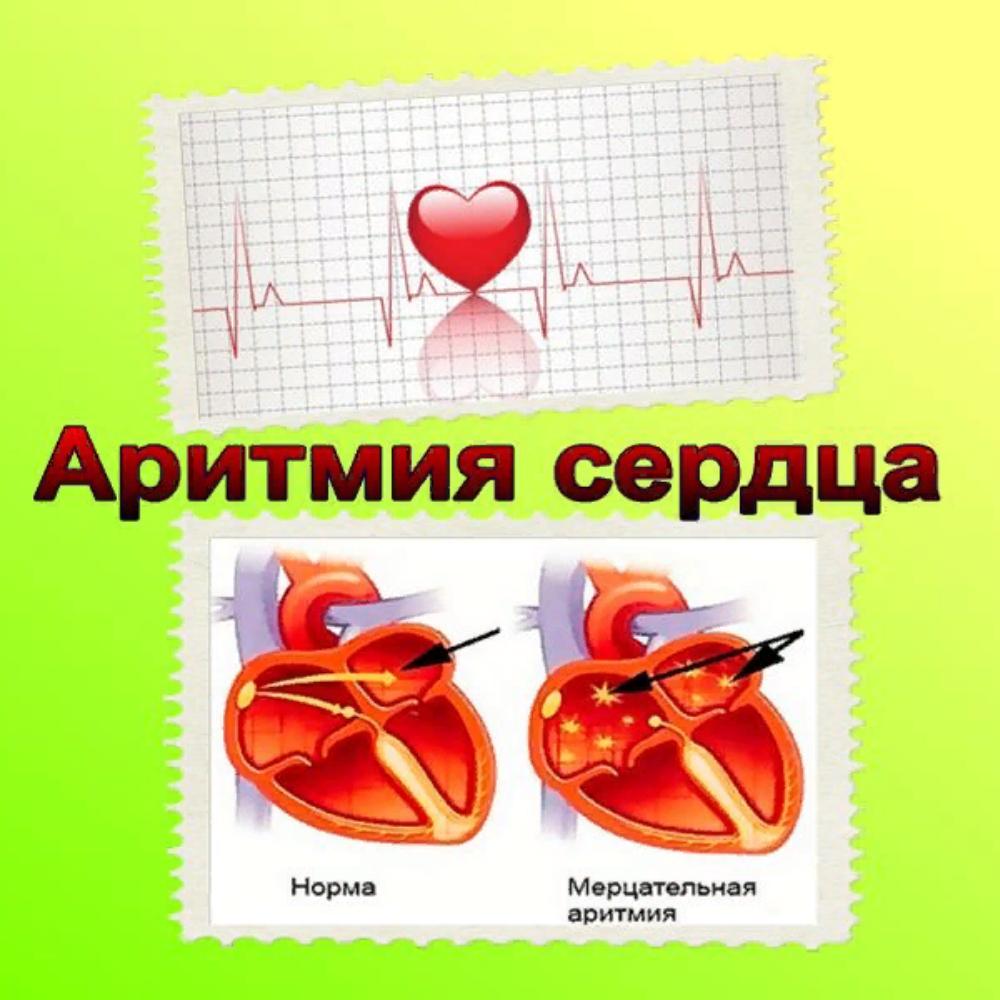 Мерцающая аритмия сердца