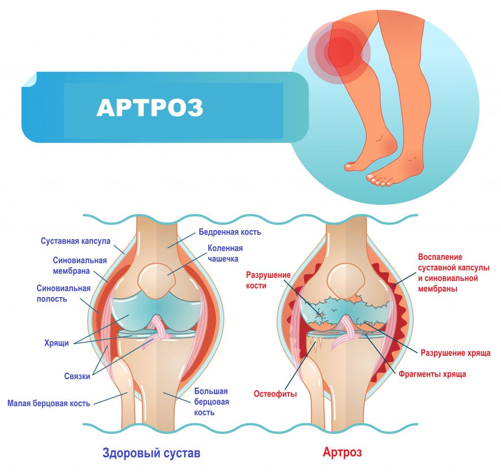 Что такое Артроз?