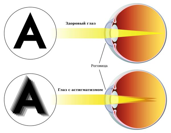 Что такое Астигматизм?