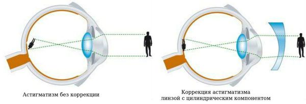 Что такое Астигматизм?