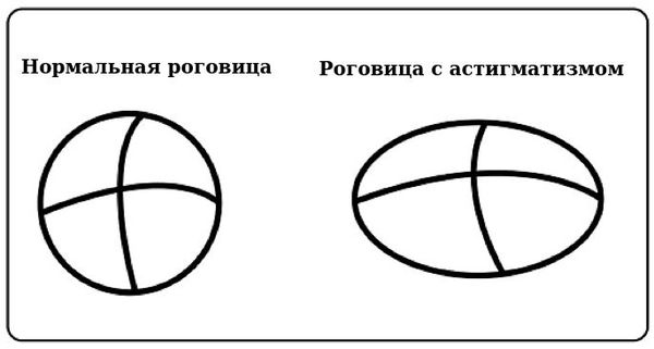 Что такое Астигматизм?