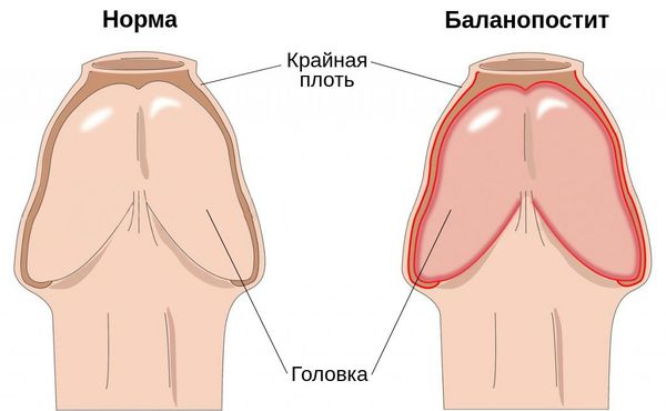 Баланопостит