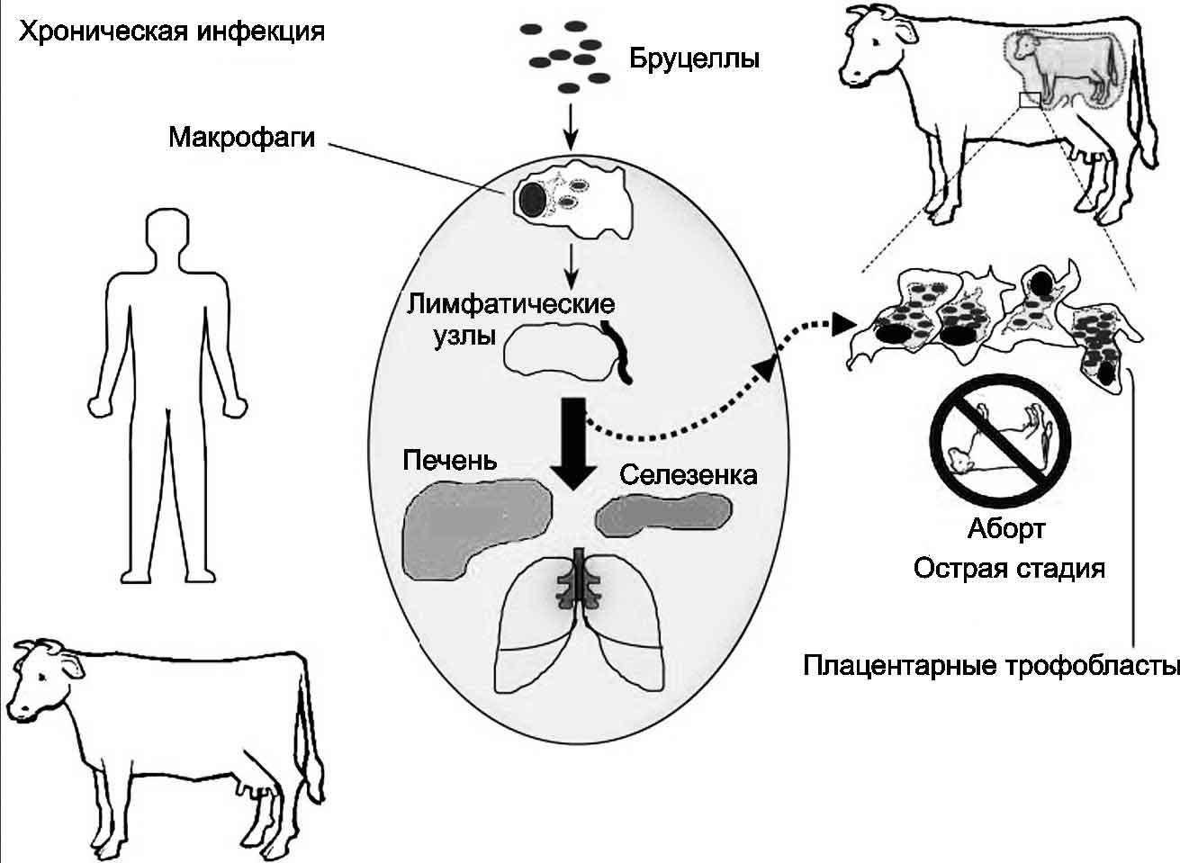 Бруцеллёз