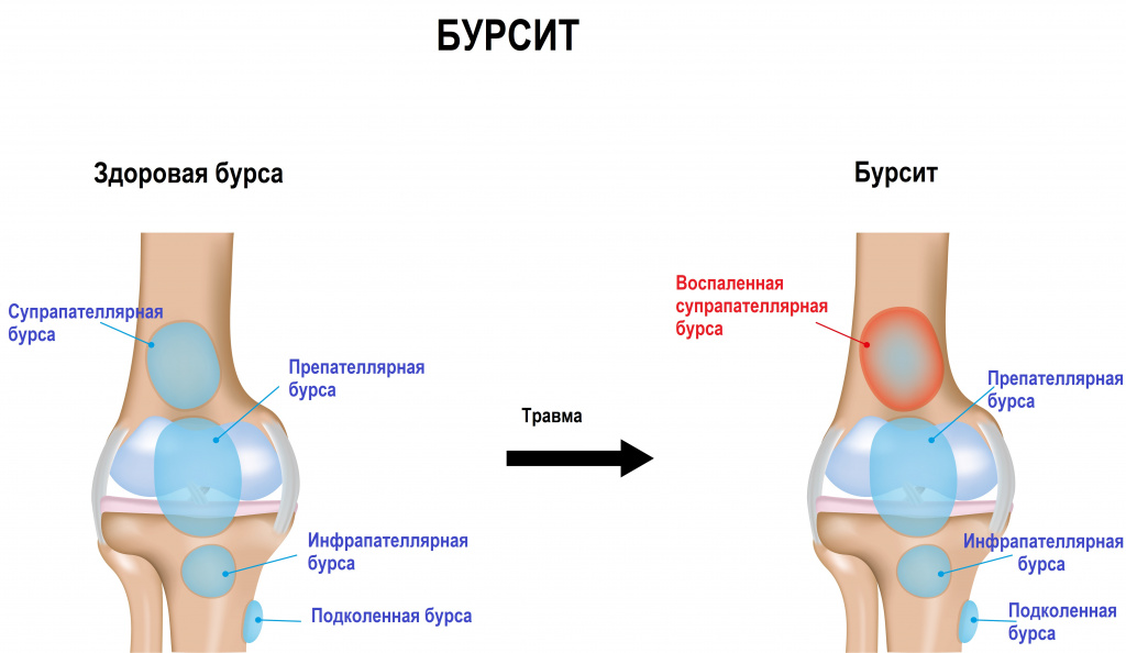 Бурсит