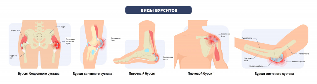 Бурсит