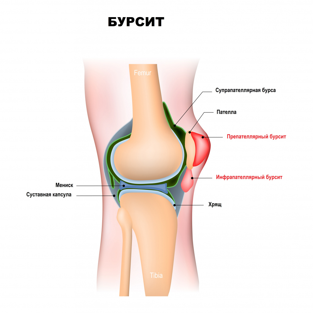 Бурсит