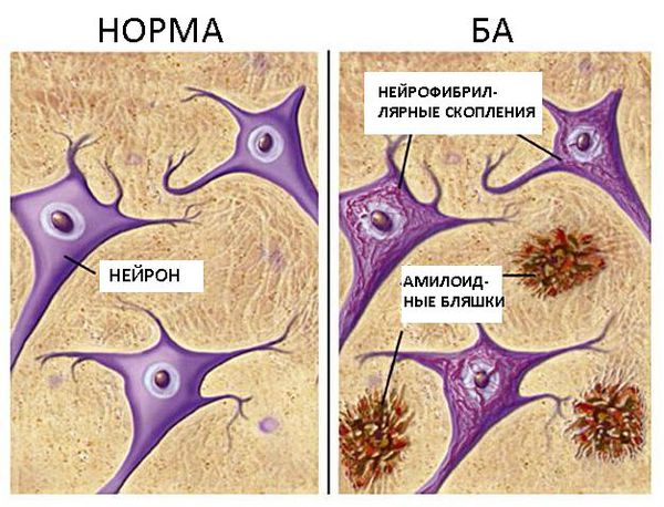 Деменция