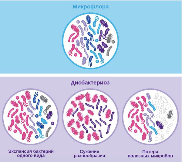 Дисбактериоз кишечника