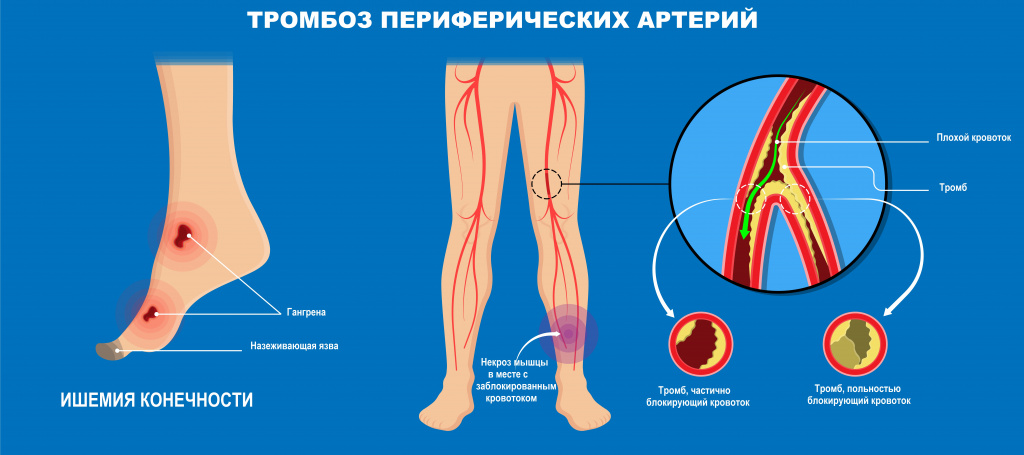 Гангрена