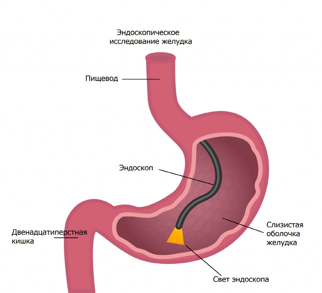 Гастрит