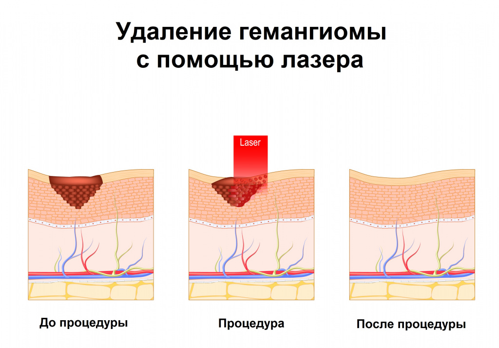 Гемангиома