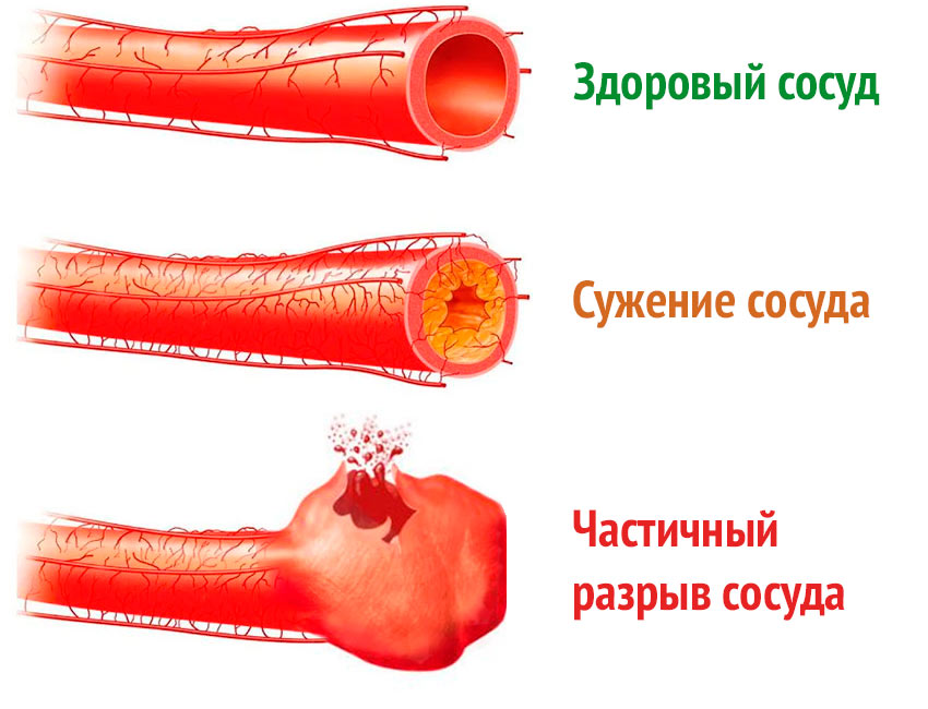 Геморрой