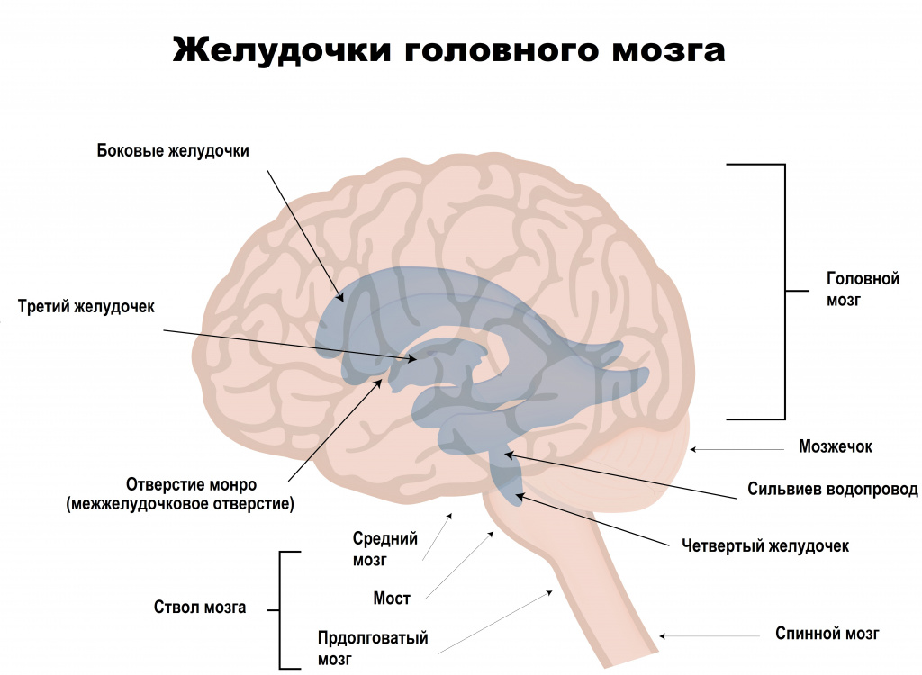 Гидроцефалия