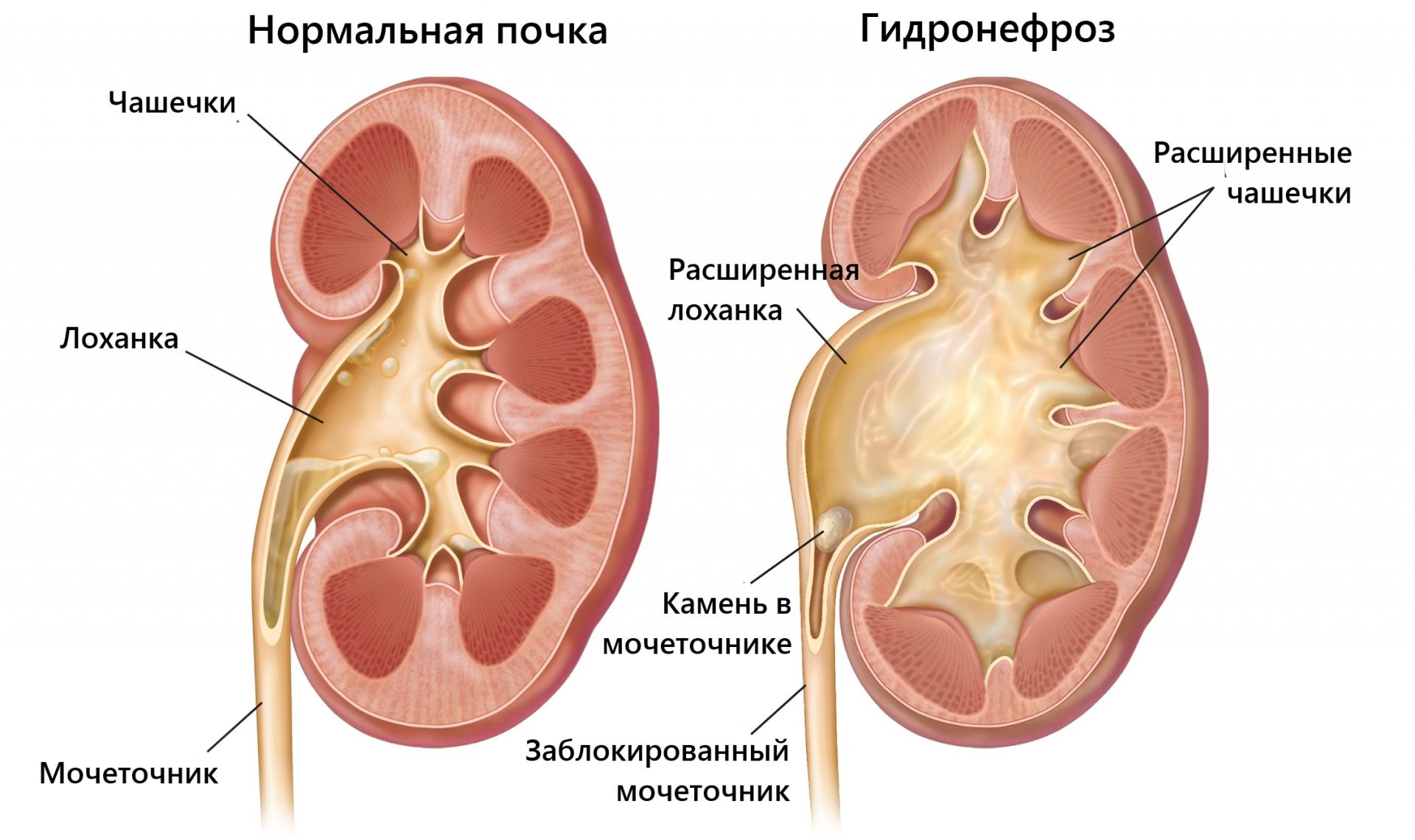 Гидронефроз