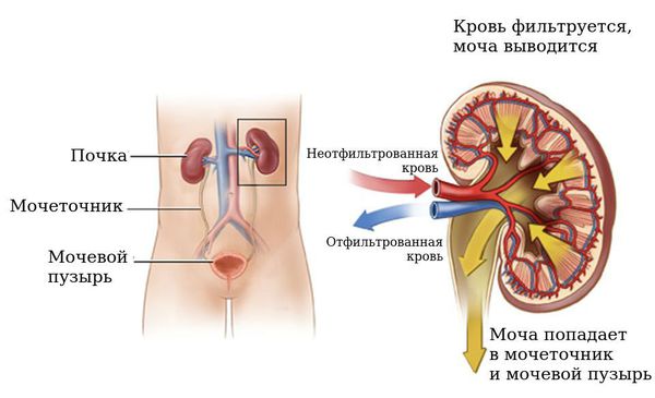 Гидронефроз