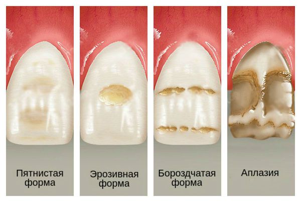 Гипоплазия