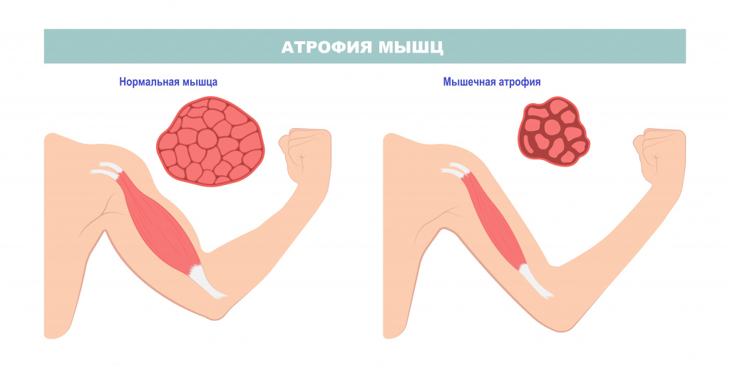 Гипотрофия