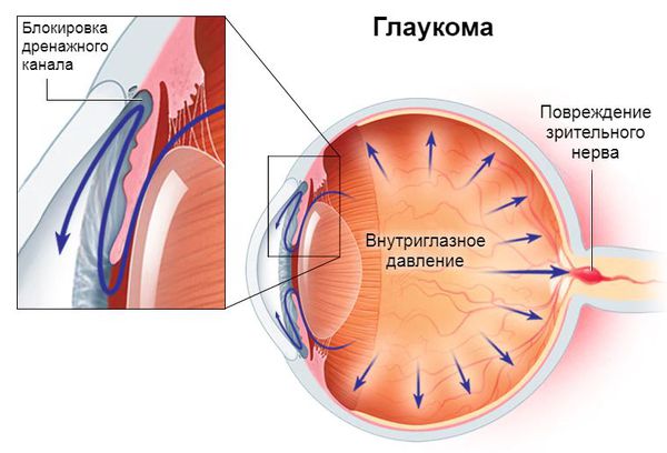 Глаукома