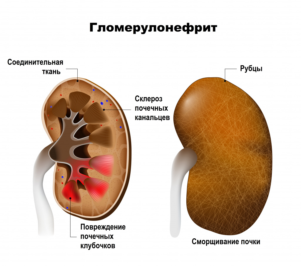 Гломерулонефрит