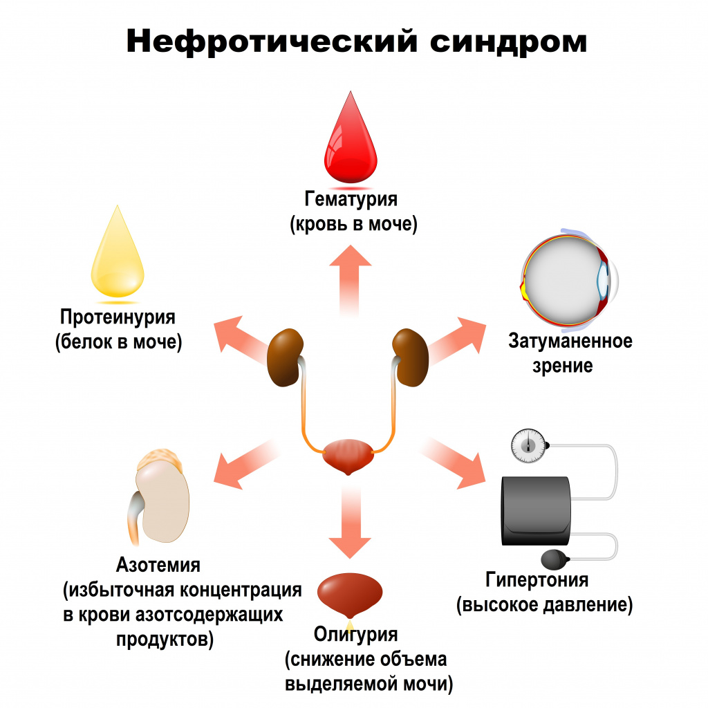 Гломерулонефрит