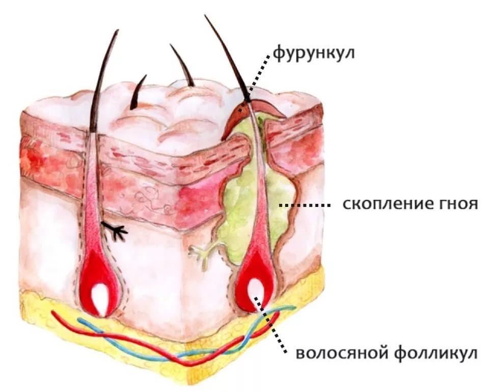 Гнойник